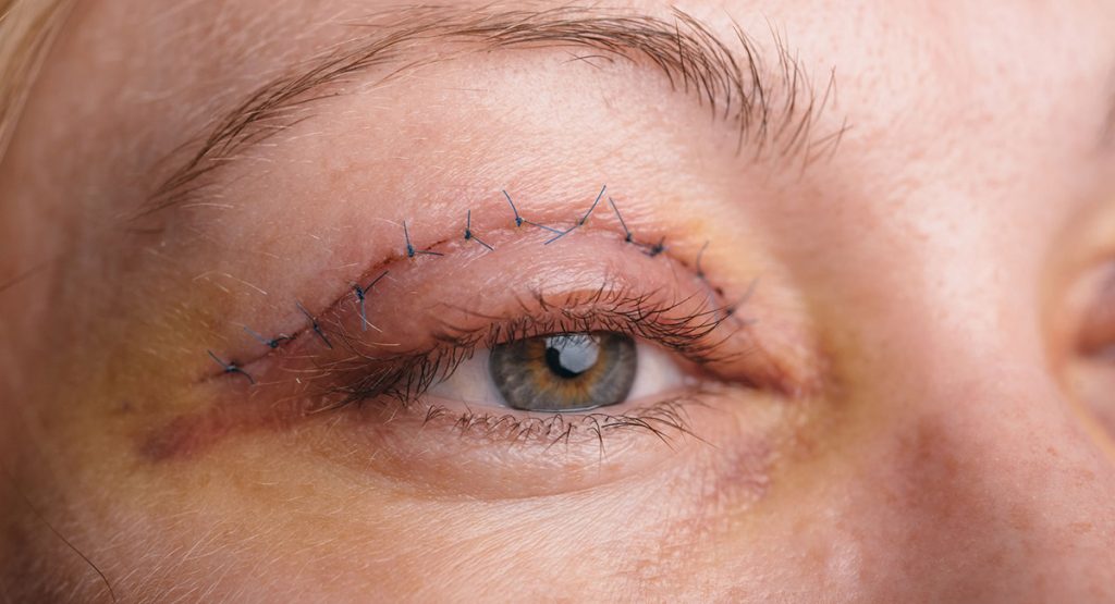 Comment guérir rapidement après une blépharoplastie